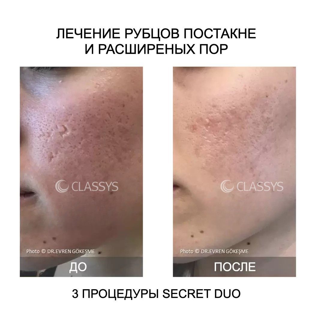 Купить аппарат для фракционного омоложения Classys Secret DUO в Украине | Alfaspa изображение 17