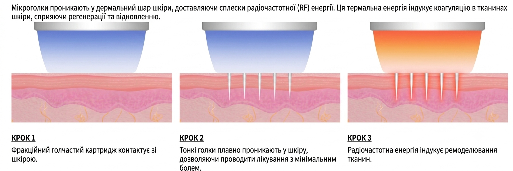 Classys Secret RF: Апарат фракційного RF-ліфтингу ➔ купити в Україні | Alfaspa зображення 14
