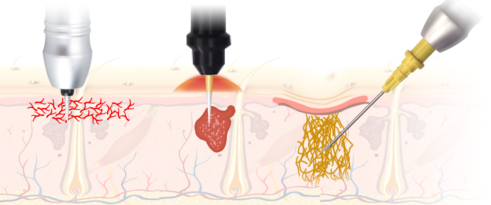 Classys Secret RF: Апарат фракційного RF-ліфтингу ➔ купити в Україні | Alfaspa зображення 39