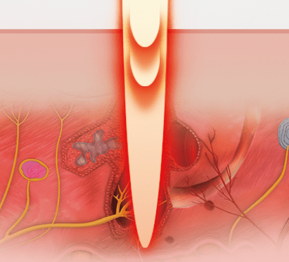Classys FRAXIS DUO ➔ Апарат фракційного CO2 та мікроголкового лазера в Україні | Alfaspa зображення 16